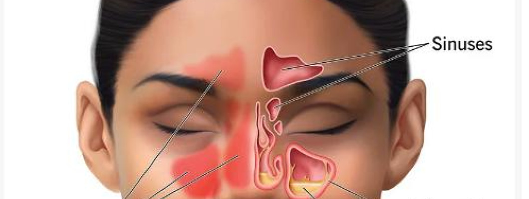 SINUS SURGERY COST IN INDIA