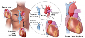 Heart Transplant in India