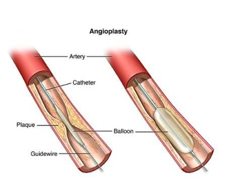 ANGIOPLASTY AND STENT PLACEMENT